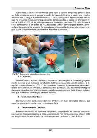 Trauma de Tórax
Além disso, a infusão de cristalóide para repor o volume sanguíneo perdido, deve
ser feita simultaneamente à descompressão da cavidade torácica e assim que possível
administra-se o sangue autotransfundido ou outro tipo-específico. Alguns autores alertam
que, na presença de sangramento persistente, caracterizado por esses por drenagem ini-
cial de 1.000 a 1.500 ml, seguido de sangramento contínuo de 200 a 300 ml/h, durante 4
horas consecutivas e em casos de HTX coagulado (ambas complicações do HTX), deve-
se fazer toracotomia de urgência (lembrando sempre que esta deve ser feita por um cirur-
gião ou por um outro médico devidamente treinado e qualificado).
5.3. Quilotórax
O quilotórax é o acúmulo de líquido linfático na cavidade pleural. Sua etiologia geral-
mente é devido a um ferimento transfixante do tórax que acomete o ducto torácico. O di-
agnóstico é semelhante ao HTX, porém quando se drena um líquido vertente, de aspecto
leitoso e rico em células linfóides, é caracterizado o quilotórax. Seu tratamento é feito pela
drenagem pleural ou por toracocentese e, complementado por uma dieta rica em triglicéri-
des, que aceleram a cicatrização da lesão do ducto.
6. Traumatismo Cardíaco
Os traumatismos cardíacos podem ser divididos em duas condições básicas, que
são o tamponamento cardíaco e a contusão cardíaca.
6.1. Tamponamento Cardíaco
Presença de líquido na cavidade pericárdica, comprimindo as câmaras cardíacas,
promovendo restrição diastólica e colapso circulatório, nas contusões a sua origem pode
ser a ruptura cardíaca ou a lesão de vasos sangüíneos cardíacos ou pericárdicos.
- 224 -
Fig 16.7 – Esquema de colocação de dreno em tórax
 