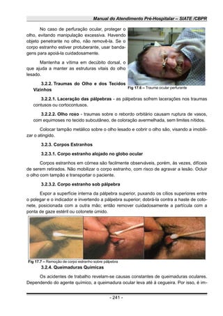 Manual do Atendimento Pré-Hospitalar – SIATE /CBPR
No caso de perfuração ocular, proteger o
olho, evitando manipulação excessiva. Havendo
objeto penetrante no olho, não removê-la. Se o
corpo estranho estiver protuberante, usar banda-
gens para apoiá-la cuidadosamente.
Mantenha a vítima em decúbito dorsal, o
que ajuda a manter as estruturas vitais do olho
lesado.
3.2.2. Traumas do Olho e dos Tecidos
Vizinhos
3.2.2.1. Laceração das pálpebras - as pálpebras sofrem lacerações nos traumas
contusos ou cortocontusos.
3.2.2.2. Olho roxo - traumas sobre o rebordo orbitário causam ruptura de vasos,
com equimoses no tecido subcutâneo, de coloração avermelhada, sem limites nítidos.
Colocar tampão metálico sobre o olho lesado e cobrir o olho são, visando a imobili-
zar o atingido.
3.2.3. Corpos Estranhos
3.2.3.1. Corpo estranho alojado no globo ocular
Corpos estranhos em córnea são facilmente observáveis, porém, às vezes, difíceis
de serem retirados. Não mobilizar o corpo estranho, com risco de agravar a lesão. Ocluir
o olho com tampão e transportar o paciente.
3.2.3.2. Corpo estranho sob pálpebra
Expor a superfície interna da pálpebra superior, puxando os cílios superiores entre
o polegar e o indicador e invertendo a pálpebra superior; dobrá-la contra a haste de coto-
nete, posicionada com a outra mão; então remover cuidadosamente a partícula com a
ponta de gaze estéril ou cotonete úmido.
3.2.4. Queimaduras Químicas
Os acidentes de trabalho revelam-se causas constantes de queimaduras oculares.
Dependendo do agente químico, a queimadura ocular leva até à cegueira. Por isso, é im-
- 241 -
Fig 17.6 – Trauma ocular perfurante
Fig 17.7 – Remoção de corpo estranho sobre pálpebra
 