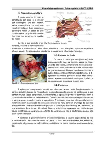 Manual do Atendimento Pré-Hospitalar – SIATE /CBPR
5. Traumatismo do Nariz
A parte superior do nariz é
constituída por osso e a inferior
por cartilagem. Em seu interior,
existe uma cavidade oca (cavidade
nasal) dividida em duas passagens
pelo septo nasal. Os ossos da face
contêm seios, os quais são cavida-
des ocas que se abrem na cavida-
de nasal.
Devido a sua posição proe-
minente, o nariz é particularmente
vulnerável a traumatismos. Além disso, distúrbios como infecções, epistaxes e pólipos
afetam o nariz. Os seios podem infectar-se e causar uma inflamação (sinusite).
5.1. Fraturas do Nariz
Os ossos do nariz quebram (fraturam) mais
freqüentemente que os demais ossos na face.
Quando isto ocorre, a membrana mucosa que re-
veste o nariz comumente é lacerada, acarretando
sangramento nasal. Como a membrana mucosa e
outros tecidos moles inflamam rapidamente, o di-
agnóstico da fratura pode ser difícil. Mais comu-
mente, a ponte nasal é deslocada para um lado e
os ossos nasais o são para o outro lado.
5.2. Epistaxes
A epistaxes (sangramento nasal) tem diversas causas. Mais freqüentemente, o
sangue provém da área de Kiesselbach, localizada na parte anterior do septo nasal e que
contém muitos vasos sangüíneos.Habitualmente, a epistaxes pode ser controlada com a
compressão de ambos os lados do nariz. Quando esta técnica não consegue interromper
o sangramento, o médico busca a sua origem. A epistaxes pode ser interrompida tempo-
rariamente com a aplicação de pressão no interior do nariz com um chumaço de algodão
embebido com um medicamento que provoca a constrição dos vasos (p.ex., fenilefrina) e
um anestésico local (p.ex., lidocaína). Quando o indivíduo apresenta um distúrbio que
causa tendência ao sangramento, a fonte do sangramento não é cauterizada porque ela
pode voltar a sangrar.
A epistaxes é geralmente óbvia e varia de moderada a severa, dependendo do tipo
e local da lesão. Sintomas de fratura de ossos do nariz incluem epistaxes, dor, edema e,
geralmente, algum grau de deformidade, mobilidade de ossos nasais e equimoses de fa-
ce.
- 245 -
Fig 17.11 – Trauma de nariz e lábio
Fig 17.10 – Anatomia do nariz
 