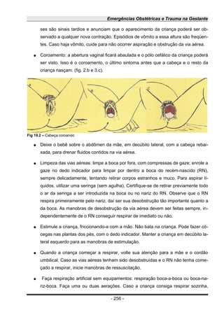 Emergências Obstétricas e Trauma na Gestante
ses são sinais tardios e anunciam que o aparecimento da criança poderá ser ob-
servado a qualquer nova contração. Episódios de vômito a essa altura são freqüen-
tes. Caso haja vômito, cuide para não ocorrer aspiração e obstrução da via aérea.
● Coroamento: a abertura vaginal ficará abaulada e o pólo cefálico da criança poderá
ser visto. Isso é o coroamento, o último sintoma antes que a cabeça e o resto da
criança nasçam. (fig. 2.b e 3.c).
● Deixe o bebê sobre o abdômen da mãe, em decúbito lateral, com a cabeça rebai-
xada, para drenar fluidos contidos na via aérea.
● Limpeza das vias aéreas: limpe a boca por fora, com compressas de gaze; enrole a
gaze no dedo indicador para limpar por dentro a boca do recém-nascido (RN),
sempre delicadamente, tentando retirar corpos estranhos e muco. Para aspirar lí-
quidos, utilizar uma seringa (sem agulha). Certifique-se de retirar previamente todo
o ar da seringa a ser introduzida na boca ou no nariz do RN. Observe que o RN
respira primeiramente pelo nariz, daí ser sua desobstrução tão importante quanto a
da boca. As manobras de desobstrução da via aérea devem ser feitas sempre, in-
dependentemente de o RN conseguir respirar de imediato ou não.
● Estimule a criança, friccionando-a com a mão. Não bata na criança. Pode fazer có-
cegas nas plantas dos pés, com o dedo indicador. Manter a criança em decúbito la-
teral esquerdo para as manobras de estimulação.
● Quando a criança começar a respirar, volte sua atenção para a mãe e o cordão
umbilical. Caso as vias aéreas tenham sido desobstruídas e o RN não tenha come-
çado a respirar, inicie manobras de ressuscitação.
● Faça respiração artificial sem equipamentos: respiração boca-a-boca ou boca-na-
riz-boca. Faça uma ou duas aerações. Caso a criança consiga respirar sozinha,
- 256 -
Fig 19.2 – Cabeça coroando
 