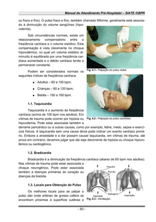 Manual do Atendimento Pré-Hospitalar – SIATE /CBPR
ou fraco e fino). O pulso fraco e fino, também chamado filiforme, geralmente está associa-
do à diminuição do volume sangüíneo (hipo-
volemia).
Sob circunstâncias normais, existe um
relacionamento compensatório entre a
freqüência cardíaca e o volume sistólico. Esta
compensação é vista claramente no choque
hipovolêmico, no qual um volume sistólico di-
minuído é equilibrado por uma freqüência car-
díaca aumentada e o débito cardíaco tende a
permanecer constante.
Podem ser considerados normais os
seguintes índices de freqüência cardíaca:
● Adultos – 60 a 100 bpm;
● Crianças – 80 a 120 bpm;
● Bebês – 100 a 160 bpm.
1.1. Taquicardia
Taquicardia é o aumento da freqüência
cardíaca (acima de 100 bpm nos adultos). Em
vítimas de trauma pode ocorrer por hipóxia ou
hipovolemia. Pode estar associada também a
derrame pericárdico ou a outras causas, como por exemplo, febre, medo, sepse e exercí-
cios físicos. A taquicardia sem uma causa óbvia pode indicar um evento cardíaco primá-
rio. Embora a ansiedade e a dor possam causar taquicardia, em vítimas de trauma, até
prova em contrário, devemos julgar que ela seja decorrente de hipóxia ou choque hipovo-
lêmico ou cardiogênico.
1.2. Bradicardia
Bradicardia é a diminuição da freqüência cardíaca (abaixo de 60 bpm nos adultos).
Nas vítimas de trauma pode estar associada a
choque neurogênico. Pode estar associada
também a doenças primárias do coração ou
doenças da tireóide.
1.3. Locais para Obtenção do Pulso
Os melhores locais para se palpar o
pulso são onde artérias de grosso calibre se
encontram próximas à superfície cutânea e
- 83 -
Fig. 6.1 - Palpação do pulso radial.
Fig. 6.2 - Palpação do pulso carotídeo.
Fig. 6.3 - Ventilação.
 