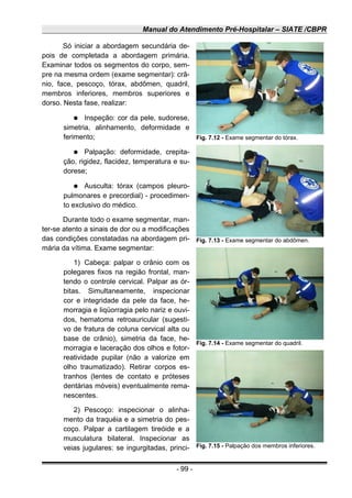 Manual do Atendimento Pré-Hospitalar – SIATE /CBPR
Só iniciar a abordagem secundária de-
pois de completada a abordagem primária.
Examinar todos os segmentos do corpo, sem-
pre na mesma ordem (exame segmentar): crâ-
nio, face, pescoço, tórax, abdômen, quadril,
membros inferiores, membros superiores e
dorso. Nesta fase, realizar:
● Inspeção: cor da pele, sudorese,
simetria, alinhamento, deformidade e
ferimento;
● Palpação: deformidade, crepita-
ção, rigidez, flacidez, temperatura e su-
dorese;
● Ausculta: tórax (campos pleuro-
pulmonares e precordial) - procedimen-
to exclusivo do médico.
Durante todo o exame segmentar, man-
ter-se atento a sinais de dor ou a modificações
das condições constatadas na abordagem pri-
mária da vítima. Exame segmentar:
1) Cabeça: palpar o crânio com os
polegares fixos na região frontal, man-
tendo o controle cervical. Palpar as ór-
bitas. Simultaneamente, inspecionar
cor e integridade da pele da face, he-
morragia e liqüorragia pelo nariz e ouvi-
dos, hematoma retroauricular (sugesti-
vo de fratura de coluna cervical alta ou
base de crânio), simetria da face, he-
morragia e laceração dos olhos e fotor-
reatividade pupilar (não a valorize em
olho traumatizado). Retirar corpos es-
tranhos (lentes de contato e próteses
dentárias móveis) eventualmente rema-
nescentes.
2) Pescoço: inspecionar o alinha-
mento da traquéia e a simetria do pes-
coço. Palpar a cartilagem tireóide e a
musculatura bilateral. Inspecionar as
veias jugulares: se ingurgitadas, princi-
- 99 -
Fig. 7.12 - Exame segmentar do tórax.
Fig. 7.13 - Exame segmentar do abdômen.
Fig. 7.14 - Exame segmentar do quadril.
Fig. 7.15 - Palpação dos membros inferiores.
 