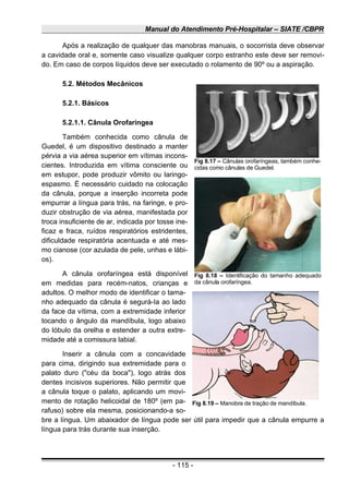 Manual do Atendimento Pré-Hospitalar – SIATE /CBPR
Após a realização de qualquer das manobras manuais, o socorrista deve observar
a cavidade oral e, somente caso visualize qualquer corpo estranho este deve ser removi-
do. Em caso de corpos líquidos deve ser executado o rolamento de 90º ou a aspiração.
5.2. Métodos Mecânicos
5.2.1. Básicos
5.2.1.1. Cânula Orofaríngea
Também conhecida como cânula de
Guedel, é um dispositivo destinado a manter
pérvia a via aérea superior em vítimas incons-
cientes. Introduzida em vítima consciente ou
em estupor, pode produzir vômito ou laringo-
espasmo. É necessário cuidado na colocação
da cânula, porque a inserção incorreta pode
empurrar a língua para trás, na faringe, e pro-
duzir obstrução de via aérea, manifestada por
troca insuficiente de ar, indicada por tosse ine-
ficaz e fraca, ruídos respiratórios estridentes,
dificuldade respiratória acentuada e até mes-
mo cianose (cor azulada de pele, unhas e lábi-
os).
A cânula orofaríngea está disponível
em medidas para recém-natos, crianças e
adultos. O melhor modo de identificar o tama-
nho adequado da cânula é segurá-Ia ao lado
da face da vítima, com a extremidade inferior
tocando o ângulo da mandíbula, logo abaixo
do lóbulo da orelha e estender a outra extre-
midade até a comissura labial.
Inserir a cânula com a concavidade
para cima, dirigindo sua extremidade para o
palato duro ("céu da boca"), logo atrás dos
dentes incisivos superiores. Não permitir que
a cânula toque o palato, aplicando um movi-
mento de rotação helicoidal de 180º (em pa-
rafuso) sobre ela mesma, posicionando-a so-
bre a língua. Um abaixador de língua pode ser útil para impedir que a cânula empurre a
língua para trás durante sua inserção.
- 115 -
Fig 8.17 – Cânulas orofaríngeas, também conhe-
cidas como cânulas de Guedel.
Fig 8.18 – Identificação do tamanho adequado
da cânula orofaríngea.
Fig 8.19 – Manobra de tração de mandíbula.
 