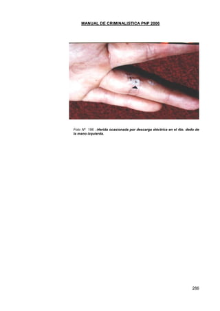 MANUAL DE CRIMINALISTICA PNP 2006
286
Foto Nº 186 .-Herida ocasionada por descarga eléctrica en el 4to. dedo de
la mano izquierda.
 