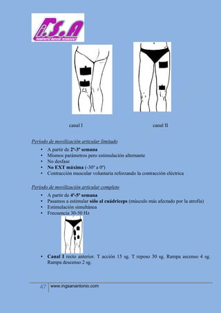 47 www.ingsanantonio.com
canal I canal II
Período de movilización articular limitado
• A partir de 2ª-3ª semana
• Mismos parámetros pero estimulación alternante
• No desfase
• No EXT máxima (-30º a 0º)
• Contracción muscular voluntaria reforzando la contracción eléctrica
Período de movilización articular completo
• A partir de 4ª-5ª semana
• Pasamos a estimular sólo al cuádriceps (músculo más afectado por la atrofia)
• Estimulación simultánea
• Frecuencia 30-50 Hz
• Canal I recto anterior. T acción 15 sg. T reposo 30 sg. Rampa ascenso 4 sg.
Rampa descenso 2 sg.
 