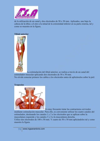 70 www.ingsanantonio.com
de la utilización de un canal y dos electrodos de 50 x 50 mm. Aplicados, uno bajo la
cabeza de la tibia y el otro a la mitad de la extremidad inferior en su parte externa, tal y
como se muestra en la figura.
Tibial anterior
La estimulación del tibial anterior, se realiza a través de un canal del
estimulador muscular aplicando dos electrodos de 50 x 50 mm.
No olvide conectar primero los cables a los electrodos antes de aplicárselos sobre la piel.
Trapecios
Es muy frecuente tratar las contracturas cervicales
mediante estimulación muscular. Para ello, es conveniente utilizar los cuatro canales del
estimulador, destinando los canales 1 y 2 a los electrodos que se aplican sobre la
musculatura izquierda y los canales 3 y 4 a la musculatura derecha.
Utilice dos electrodos de 100 x 50 mm. Y cuatro de 50 x 50 mm aplicándolos tal y como
muestra la figura.
 