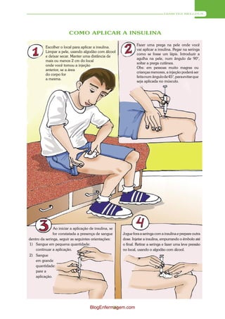 DIABETES MELLITUS




                         COMO APLICAR A INSULINA

                                                                 Fazer uma prega na pele onde você
          Escolher o local para aplicar a insulina.
                                                                 vai aplicar a insulina. Pegar na seringa
          Limpar a pele, usando algodão com álcool
                                                                 como se fosse um lápis. Introduzir a
          e deixar secar. Manter uma distância de
                                                                 agulha na pele, num ângulo de 90°,
          mais ou menos 2 cm do local
                                                                 soltar a prega cutânea.
          onde você tomou a injeção
                                                                 Obs: em pessoas muito magras ou
          anterior, se a área
                                                                 crianças menores, a injeção poderá ser
          do corpo for
                                                                 feita num ângulo de 45°, para evitar que
          a mesma.
                                                                 seja aplicada no músculo.




               Ao iniciar a aplicação de insulina, se
               for constatada a presença de sangue      Jogue fora a seringa com a insulina e prepare outra
dentro da seringa, seguir as seguintes orientações:     dose. Injetar a insulina, empurrando o êmbolo até
1) Sangue em pequena quantidade:                        o final. Retirar a seringa e fazer uma leve pressão
    continuar a aplicação.                              no local, usando o algodão com álcool.
2) Sangue
   em grande
   quantidade:
   pare a
   aplicação.




                                      BlogEnfermagem.com
                                                99
 