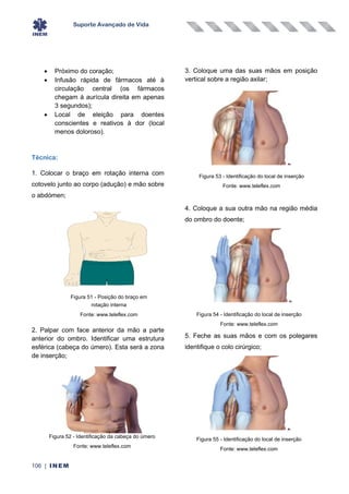 Suporte Avançado de Vida
106 | INEM
• Próximo do coração;
• Infusão rápida de fármacos até à
circulação central (os fármacos
chegam à aurícula direita em apenas
3 segundos);
• Local de eleição para doentes
conscientes e reativos à dor (local
menos doloroso).
Técnica:
1. Colocar o braço em rotação interna com
cotovelo junto ao corpo (adução) e mão sobre
o abdómen;
2. Palpar com face anterior da mão a parte
anterior do ombro. Identificar uma estrutura
esférica (cabeça do úmero). Esta será a zona
de inserção;
3. Coloque uma das suas mãos em posição
vertical sobre a região axilar;
4. Coloque a sua outra mão na região média
do ombro do doente;
5. Feche as suas mãos e com os polegares
identifique o colo cirúrgico;
Figura 53 - Identificação do local de inserção
Fonte: www.teleflex.com
Figura 51 - Posição do braço em
rotação interna
Fonte: www.teleflex.com Figura 54 - Identificação do local de inserção
Fonte: www.teleflex.com
Figura 55 - Identificação do local de inserção
Fonte: www.teleflex.com
Figura 52 - Identificação da cabeça do úmero
Fonte: www.teleflex.com
 