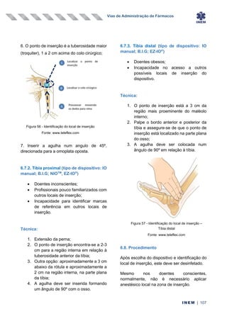 Vias de Administração de Fármacos
INEM | 107
6. O ponto de inserção é a tuberosidade maior
(troquiter), 1 a 2 cm acima do colo cirúrgico;
7. Inserir a agulha num angulo de 45º,
direcionada para a omoplata oposta.
6.7.2. Tíbia proximal (tipo de dispositivo: IO
manual; B.I.G; NIOTM
, EZ-IO®
)
• Doentes inconscientes;
• Profissionais pouco familiarizados com
outros locais de inserção;
• Incapacidade para identificar marcas
de referência em outros locais de
inserção.
Técnica:
1. Extensão da perna;
2. O ponto de inserção encontra-se a 2-3
cm para a região interna em relação à
tuberosidade anterior da tíbia;
3. Outra opção: aproximadamente a 3 cm
abaixo da rótula e aproximadamente a
2 cm na região interna, na parte plana
da tíbia;
4. A agulha deve ser inserida formando
um ângulo de 90º com o osso.
6.7.3. Tíbia distal (tipo de dispositivo: IO
manual; B.I.G; EZ-IO®
)
• Doentes obesos;
• Incapacidade no acesso a outros
possíveis locais de inserção do
dispositivo.
Técnica:
1. O ponto de inserção está a 3 cm da
região mais proeminente do maléolo
interno;
2. Palpe o bordo anterior e posterior da
tíbia e assegure-se de que o ponto de
inserção está localizado na parte plana
do osso;
3. A agulha deve ser colocada num
ângulo de 90º em relação à tíbia.
6.8. Procedimento
Após escolha do dispositivo e identificação do
local de inserção, este deve ser desinfetado.
Mesmo nos doentes conscientes,
normalmente, não é necessário aplicar
anestésico local na zona de inserção.
Figura 56 - Identificação do local de inserção
Fonte: www.teleflex.com
Figura 57 - Identificação do local de inserção –
Tíbia distal
Fonte: www.teleflex.com
 