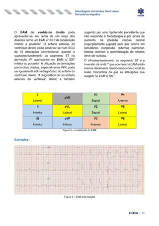 Abordagem Inicial dos Síndromes
Coronários Agudos
INEM | 37
O EAM do ventrículo direito pode
apresentar-se em cerca de um terço dos
doentes como um EAM c/ SST de localização
inferior e posterior. O enfarte extenso do
ventrículo direito pode observar-se num ECG
de 12 derivações convencional, quando o
supradesnivelamento do segmento ST na
derivação V1 acompanha um EAM c/ SST
inferior ou posterior. A utilização de derivações
precordiais direitas, especialmente V4R, pode
ser igualmente útil no diagnóstico do enfarte do
ventrículo direito. O diagnóstico de um enfarte
extenso do ventrículo direito é também
sugerido por uma hipotensão persistente que
não responde à fluidoterapia e por sinais de
aumento da pressão venosa central
(ingurgitamento jugular) sem que ocorra em
simultâneo congestão (edema) pulmonar.
Nestes doentes a administração de nitratos
deve ser evitada.
O infradesnivelamento do segmento ST e a
inversão da onda T que ocorrem no EAM estão
menos claramente relacionados com o local da
lesão miocárdica do que as alterações que
surgem no EAM c/ SST.
I
Lateral
aVR
V1
Septal
V4
Anterior
II
Inferior
aVL
Lateral
V2
Septal
V5
Lateral
III
Inferior
aVF
Inferior
V3
Anterior
V6
Lateral
Figura 3 – Localização do EAM
Exemplos:
Figura 4 – EAM anteroseptal
 