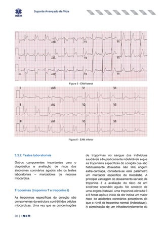 Suporte Avançado de Vida
38 | INEM
Figura 5 - EAM lateral
Figura 6 - EAM inferior
3.3.2. Testes laboratoriais
Outros componentes importantes para o
diagnóstico e avaliação de risco dos
síndromes coronários agudos são os testes
laboratoriais – marcadores de necrose
miocárdica.
Troponinas (troponina T e troponina I)
As troponinas específicas do coração são
componentes da estrutura contrátil das células
miocárdicas. Uma vez que as concentrações
de troponinas no sangue dos indivíduos
saudáveis são praticamente indetetáveis e que
as troponinas específicas do coração que são
habitualmente doseadas não têm origem
extra-cardíaca, considera-se este parâmetro
um marcador específico do miocárdio. A
principal vantagem do doseamento seriado da
troponina é a avaliação do risco de um
síndrome coronário agudo. No contexto de
uma angina instável, uma troponina elevada 6
a 8 horas após o início da dor indica um maior
risco de acidentes coronários posteriores do
que o nível de troponina normal (indetetável).
A combinação de um infradesnivelamento do
 