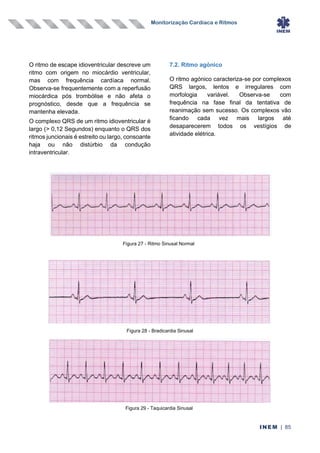 Monitorização Cardíaca e Ritmos
INEM | 85
O ritmo de escape idioventricular descreve um
ritmo com origem no miocárdio ventricular,
mas com frequência cardíaca normal.
Observa-se frequentemente com a reperfusão
miocárdica pós trombólise e não afeta o
prognóstico, desde que a frequência se
mantenha elevada.
O complexo QRS de um ritmo idioventricular é
largo (> 0,12 Segundos) enquanto o QRS dos
ritmos juncionais é estreito ou largo, consoante
haja ou não distúrbio da condução
intraventricular.
7.2. Ritmo agónico
O ritmo agónico caracteriza-se por complexos
QRS largos, lentos e irregulares com
morfologia variável. Observa-se com
frequência na fase final da tentativa de
reanimação sem sucesso. Os complexos vão
ficando cada vez mais largos até
desaparecerem todos os vestígios de
atividade elétrica.
Figura 27 - Ritmo Sinusal Normal
Figura 28 - Bradicardia Sinusal
Figura 29 - Taquicardia Sinusal
 