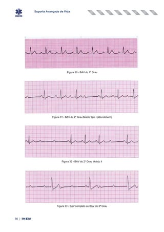 Suporte Avançado de Vida
86 | INEM
Figura 30 - BAV do 1º Grau
Figura 31 - BAV do 2º Grau Mobitz tipo I (Wenckbach)
Figura 32 - BAV do 2º Grau Mobitz II
Figura 33 - BAV completo ou BAV do 3ª Grau
 