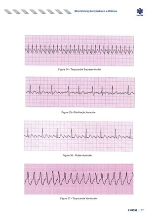 Monitorização Cardíaca e Ritmos
INEM | 87
Figura 34 - Taquicardia Supraventricular
Figura 36 - Flutter Auricular
Figura 35 - Fibrilhação Auricular
Figura 37 - Taquicardia Ventricular
 