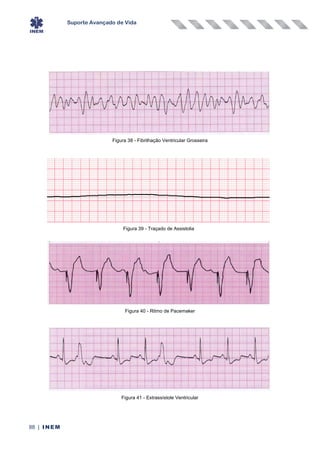 Suporte Avançado de Vida
88 | INEM
Figura 38 - Fibrilhação Ventricular Grosseira
Figura 39 - Traçado de Assistolia
Figura 40 - Ritmo de Pacemaker
Figura 41 - Extrassístole Ventricular
 