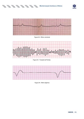 Monitorização Cardíaca e Ritmos
INEM | 89
Figura 42 - Ritmo Juncional
Figura 43 - Torsade de Pointes
Figura 44 - Ritmo Agónico
 