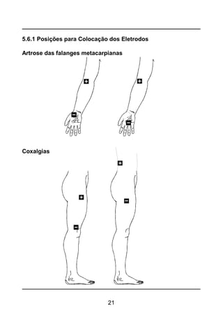 21
5.6.1 Posições para Colocação dos Eletrodos
Artrose das falanges metacarpianas
Coxalgias
 