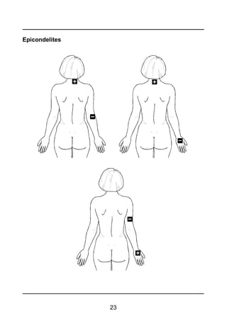 23
Epicondelites
 
