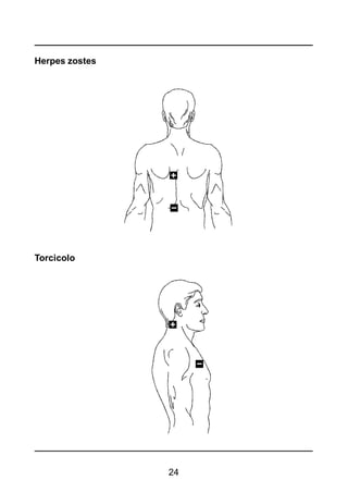 24
Herpes zostes
Torcicolo
 