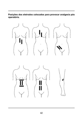 42
Posições dos eletrodos colocados para provocar analgesia pós
operatória.
 