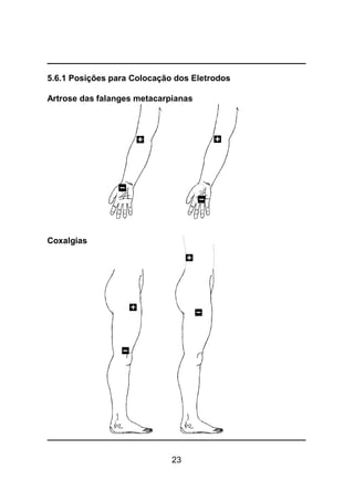 23
5.6.1 Posições para Colocação dos Eletrodos
Artrose das falanges metacarpianas
Coxalgias
 