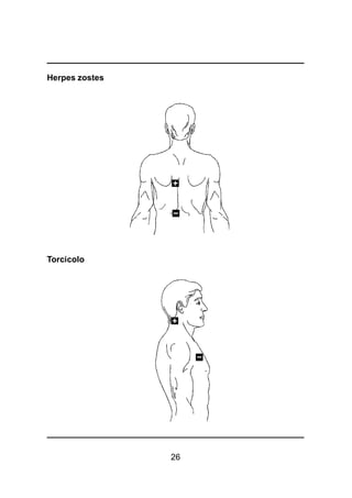 26
Herpes zostes
Torcicolo
 
