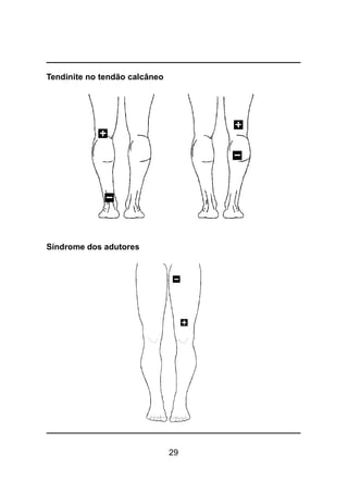 29
Tendinite no tendão calcâneo
Síndrome dos adutores
 
