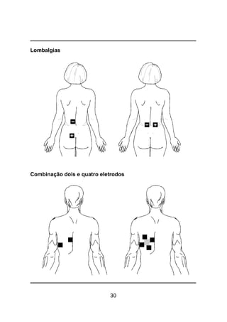 30
Lombalgias
Combinação dois e quatro eletrodos
 