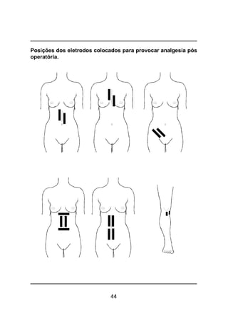 44
Posições dos eletrodos colocados para provocar analgesia pós
operatória.
 