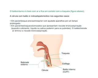O balãointerno é cheio com ar e fica em contato com a traqueia (figura abaixo).
A cânula com balão é indicadapelomédico nos seguintes casos:
• Em pacientesque precisamrespirar com ajudade aparelhos por um tempo
prolongado;
• Em pacientestraqueostomizados que apresentam riscode broncoaspiração
(quando o alimento, líquido ou saliva podemir para os pulmões). O balãocheiode
ar diminui o riscode broncoaspiração.
Balonete
externo
Cânula
Traqueia
Esôfago
Balão interno
(CUFF)
 