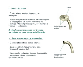 1. CÂNULA EXTERNA
• É colocada na abertura do pescoço e
datraqueia.
• Possui uma placa com aberturas nas laterais para
a colocação de um fixador com velcro ou
cadarço (fita dealgodãosarjado), que manterá a
cânula na traqueia.
A cânula externanãopode ser trocada
ou retirada em casa, exceto apósliberação.
2. CÂNULA INTERNA OU INTERMEDIÁRIO
• É encaixada dentroda cânula externa.
• Deve ser retirada frequentemente para
limpeza (4 vezes ao dia).
• Assim que for realizada a limpeza, é necessário
recolocar a cânula internadentro
dacânula externa.
Placa
Aberturas para fixar
a cânula
Conector com trava
giratória (em
alguns modelos)
 