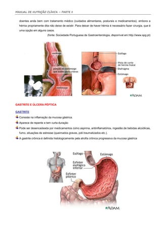 MANUAL DE NUTRIÇÃO CLÍNICA – PARTE II


  doentes anda bem com tratamento médico (cuidados alimentares, posturais e medicamentos), embora a
  hérnia propriamente dita não deixe de existir. Para deixar de haver hérnia é necessário fazer cirurgia, que é
  uma opção em alguns casos.
                         (fonte: Sociedade Portuguesa de Gastroenterologia, disponível em http://www.spg.pt)




GASTRITE E ÚLCERA PÉPTICA

GASTRITE
  Consiste na inflamação da mucosa gástrica.
  Aparece de repente e tem curta duração
  Pode ser desencadeada por medicamentos como aspirina, antiinflamatórios, ingestão de bebidas alcoólicas,
  fumo, situações de estresse (queimados graves, poli traumatizados etc.).
  A gastrite crônica é definida histologicamente pela atrofia crônica progressiva da mucosa gástrica
 