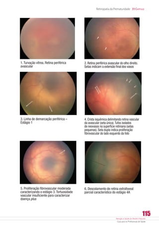 Atenção à Saúde do Recém-Nascido
Guia para os Profissionais de Saúde
115
Retinopatia da Prematuridade 39 Capítulo
1. Turvação vítrea. Retina periférica
avascular
2. Retina periférica avascular do olho direito.
Setas indicam a extensão final dos vasos
3. Linha de demarcação periférica –
Estágio 1
4. Crista isquêmica delimitando retina vascular
da avascular (seta única).Tufos isolados
de neovasos na superfície retiniana (setas
pequenas). Seta dupla indica proliferação
fibrovascular do lado esquerdo da foto
5. Proliferação fibrovascular moderada
caracterizando o estágio 3. Tortuosidade
vascular insuficiente para caracterizar
doença plus
6. Descolamento de retina extrafoveal
parcial característico do estágio 4A
 