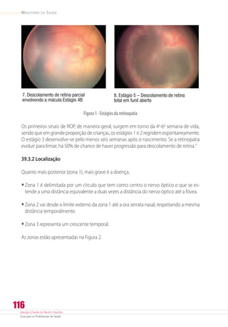 Atenção à Saúde do Recém-Nascido
Guia para os Profissionais de Saúde
116
Ministério da Saúde
7. Descolamento de retina parcial
envolvendo a mácula Estágio 4B
8. Estágio 5 – Descolamento de retina
total em funil aberto
Figura1-Estágiosdaretinopatia
Os primeiros sinais de ROP, de maneira geral, surgem em torno da 4a
-6a
semana de vida,
sendo que em grande proporção de crianças, os estágios 1 e 2 regridem espontaneamente.
O estágio 3 desenvolve-se pelo menos seis semanas após o nascimento. Se a retinopatia
evoluir para limiar, há 50% de chance de haver progressão para descolamento de retina.11
39.3.2 Localização
Quanto mais posterior (zona 1), mais grave é a doença.
•	Zona 1 é delimitada por um círculo que tem como centro o nervo óptico e que se es-
tende a uma distância equivalente a duas vezes a distância do nervo óptico até a fóvea.
•	Zona 2 vai desde o limite externo da zona 1 até a ora serrata nasal, respeitando a mesma
distância temporalmente.
•	Zona 3 representa um crescente temporal.
As zonas estão apresentadas na Figura 2.
 