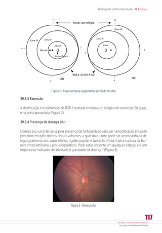Atenção à Saúde do Recém-Nascido
Guia para os Profissionais de Saúde
117
Retinopatia da Prematuridade 39 Capítulo
Clique para adicionar um subtítulo
12 12
66
3
9
3
9
horas do relógio
Zona III
Zona III
Zona II Zona II
Zona I Zona I
Mácula
Nervo Óptico
“OR A S E R R ATA”
OD OE
Figura2-Representaçãoesquemáticadofundodeolho
39.3.3 Extensão
A distribuição circunferencial da ROP é relatada em horas do relógio em setores de 30 graus,
e na zona apropriada (Figura 2).
39.3.4 Presença de doença plus
Doença plus caracteriza-se pela presença de tortuosidade vascular, venodilatação em polo
posterior em pelo menos dois quadrantes, a qual mais tarde pode ser acompanhada de
ingurgitamento dos vasos irianos, rigidez pupilar e turvação vítrea (indica ruptura da bar-
reira vítreo-retiniana e pior prognóstico). Pode estar presente em qualquer estágio e é um
importante indicador de atividade e gravidade da doença18
(Figura 3).
Figura3-Doençaplus
 