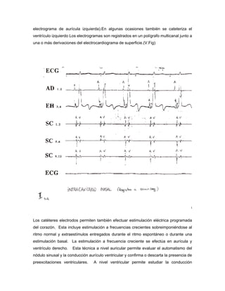 electrograma de aurícula izquierda).En algunas ocasiones también se cateteriza el
ventrículo izquierdo Los electrogramas son registrados en un polígrafo multicanal junto a
una o más derivaciones del electrocardiograma de superficie.(V.Fig)




Los catéteres electrodos permiten también efectuar estimulación eléctrica programada
del corazón. Esta incluye estimulación a frecuencias crecientes sobreimponiéndose al
ritmo normal y extraestímulos entregados durante el ritmo espontáneo o durante una
estimulación basal. La estimulación a frecuencia creciente se efectúa en aurícula y
ventrículo derecho.   Esta técnica a nivel auricular permite evaluar el automatismo del
nódulo sinusal y la conducción aurículo ventricular y confirma o descarta la presencia de
preexcitaciones ventriculares.    A nivel ventricular permite estudiar la conducción
 