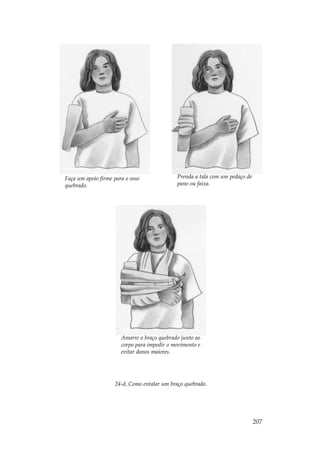 Faça um apoio firme para o osso              Prenda a tala com um pedaço de
quebrado.                                    pano ou faixa.




                       Amarre o braço quebrado junto ao
                       corpo para impedir o movimento e
                       evitar danos maiores.




                    24-d, Como entalar um braço quebrado.




                                                                              207
 