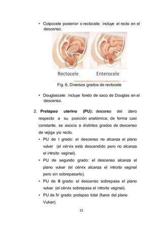 15
• Colpocele posterior o rectocele: incluye el recto en el
descenso.
Fig. 6. Diversos grados de rectocele
• Douglascele: incluye fondo de saco de Douglas en el
descenso.
2. Prolapso uterino (PU): descenso del útero
respecto a su posición anatómica; de forma casi
constante, se asocia a distintos grados de descenso
de vejiga y/o recto.
• PU de I grado: el descenso no alcanza el plano
vulvar (el cérvix está descendido pero no alcanza
el introito vaginal).
• PU de segundo grado: el descenso alcanza el
plano vulvar (el cérvix alcanza el introito vaginal
pero sin sobrepasarlo).
• PU de III grado: el descenso sobrepasa el plano
vulvar (el cérvix sobrepasa el introito vaginal).
• PU de IV grado: prolapso total (fuera del plano
Vulvar).
 