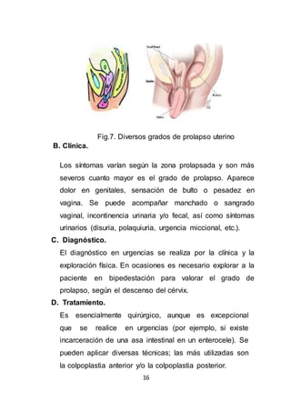 16
Fig.7. Diversos grados de prolapso uterino
B. Clínica.
Los síntomas varían según la zona prolapsada y son más
severos cuanto mayor es el grado de prolapso. Aparece
dolor en genitales, sensación de bulto o pesadez en
vagina. Se puede acompañar manchado o sangrado
vaginal, incontinencia urinaria y/o fecal, así como síntomas
urinarios (disuria, polaquiuria, urgencia miccional, etc.).
C. Diagnóstico.
El diagnóstico en urgencias se realiza por la clínica y la
exploración física. En ocasiones es necesario explorar a la
paciente en bipedestación para valorar el grado de
prolapso, según el descenso del cérvix.
D. Tratamiento.
Es esencialmente quirúrgico, aunque es excepcional
que se realice en urgencias (por ejemplo, si existe
incarceración de una asa intestinal en un enterocele). Se
pueden aplicar diversas técnicas; las más utilizadas son
la colpoplastia anterior y/o la colpoplastia posterior.
 