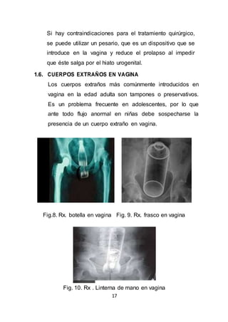 17
Si hay contraindicaciones para el tratamiento quirúrgico,
se puede utilizar un pesario, que es un dispositivo que se
introduce en la vagina y reduce el prolapso al impedir
que éste salga por el hiato urogenital.
1.6. CUERPOS EXTRAÑOS EN VAGINA
Los cuerpos extraños más comúnmente introducidos en
vagina en la edad adulta son tampones o preservativos.
Es un problema frecuente en adolescentes, por lo que
ante todo flujo anormal en niñas debe sospecharse la
presencia de un cuerpo extraño en vagina.
Fig.8. Rx. botella en vagina Fig. 9. Rx. frasco en vagina
Fig. 10. Rx . Linterna de mano en vagina
 