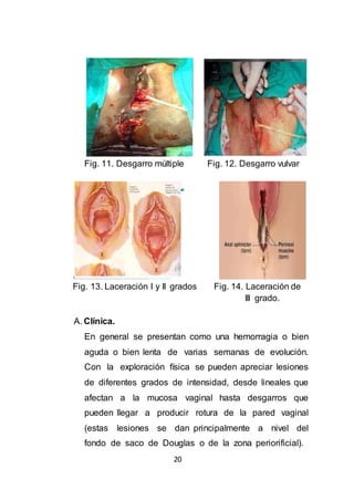 20
Fig. 11. Desgarro múltiple Fig. 12. Desgarro vulvar
Fig. 13. Laceración I y II grados Fig. 14. Laceración de
III grado.
A. Clínica.
En general se presentan como una hemorragia o bien
aguda o bien lenta de varias semanas de evolución.
Con la exploración física se pueden apreciar lesiones
de diferentes grados de intensidad, desde lineales que
afectan a la mucosa vaginal hasta desgarros que
pueden llegar a producir rotura de la pared vaginal
(estas lesiones se dan principalmente a nivel del
fondo de saco de Douglas o de la zona periorificial).
 