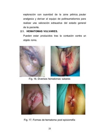 23
exploración con suavidad de la zona pélvica, pautar
analgesia y derivar al equipo de politraumatismos para
realizar una valoración exhaustiva del estado general
de la paciente.
2.1. HEMATOMAS VULVARES.
Pueden estar producidos tras la contusión contra un
objeto romo.
Fig. 16. Diversos hematomas vulvares
Fig. 17. Formas de hematoma post episiorrafia
 