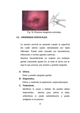 25
Fig. 18. Diversos desgarros cervicales.
2.3. EROSIONES CERVICALES.
La erosión cervical se presenta cuando la superficie
del cuello uterino queda reemplazada por tejido
inflamado. Puede estar causada por traumatismos,
infecciones o ciertos agentes químicos.
Aparece frecuentemente en mujeres con prolapso
genital importante (grado IV), al rozar el cérvix con la
ropa lo que provoca una erosión y posible sangrado.
A. Clínica.
Dolor y posible sangrado genital.
B. Diagnóstico.
Clínico y mediante la exploración (especuloscopia).
C. Tratamiento.
Identificar la causa y tratarla. Se pueden utilizar
tratamientos tópicos para calmar el dolor,
antibióticos si existe sobreinfección y pautar
analgesia si es preciso.
 