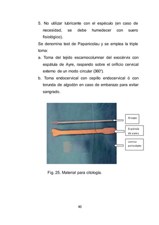 40
5. No utilizar lubricante con el espéculo (en caso de
necesidad, se debe humedecer con suero
fisiológico).
Se denomina test de Papanicolau y se emplea la triple
toma:
a. Toma del tejido escamocolumnar del exocérvix con
espátula de Ayre, raspando sobre el orificio cervical
externo de un modo circular (360°).
b. Toma endocervical con cepillo endocervical ó con
torunda de algodón en caso de embarazo para evitar
sangrado.
Fig. 25. Material para citología.
Hisopo
Espátula
de ayres
ayresLámina
portaobjeto
 