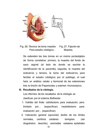 41
Fig. 26. Técnica de toma muestra Fig. 27. Fijación de
Para estudio citológico. Muestra.
Se extienden las tres tomas en un mismo portaobjetos
de forma correlativa: primero, la muestra del fondo de
saco vaginal (al lado de donde se escribe la
identificación de la paciente), segundo, la muestra del
ectocérvix y tercero, la toma del endocérvix, para
facilitar el estudio citológico por el patólogo, el cual
hará un análisis celular y hormonal de las extensiones
tras la tinción de Papanicolau y examen microscópico.
B. Resultados de la citología.
Los informes de los resultados de la citología se
clasifican por el sistema Bethesda:
1. Validéz del frotís: satisfactorio para evaluación, pero
limitado por… (especificar), insatisfactorio para
evaluación por… (especificar).
2. Valoración general (opcional): dentro de los límites
normales, cambios celulares benignos (ver
diagnóstico descrito), anomalías celulares epiteliales
 