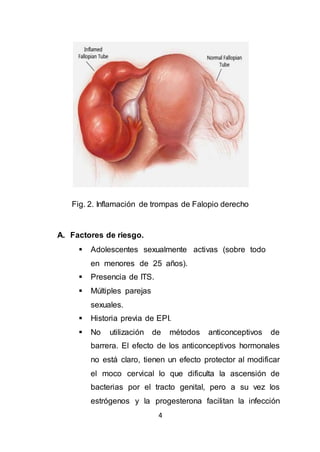 4
Fig. 2. Inflamación de trompas de Falopio derecho
A. Factores de riesgo.
 Adolescentes sexualmente activas (sobre todo
en menores de 25 años).
 Presencia de ITS.
 Múltiples parejas
sexuales.
 Historia previa de EPI.
 No utilización de métodos anticonceptivos de
barrera. El efecto de los anticonceptivos hormonales
no está claro, tienen un efecto protector al modificar
el moco cervical lo que dificulta la ascensión de
bacterias por el tracto genital, pero a su vez los
estrógenos y la progesterona facilitan la infección
 