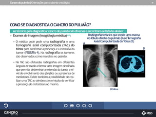 Cancrodopulmão|Orientaçõesparaodoenteoncológico 19
COMOSE DIAGNOSTICAOCANCRODOPULMÃO?
Astécnicasparadiagnosticarcancrodopulmãosãodiversaseencontram-selistadasabaixo:
» Examesdeimagem(imagiologiamédica)1,8,15:
» O médico pode pedir uma radiografia e uma
tomografia axial computorizada (TAC) do
tórax para confirmar apresença eaextensão do
tumor (FIGURA 4).Na radiografia os tumores
são observados como manchas no pulmão.
» Na TAC são efetuadas radiografias em diferentes
ângulosdemodoaformarumaimagemdetalhada
que permita determinar aextensão do tumor
,o ní-
veldeenvolvimento dos gânglios ou apresença de
metástases. Existe também apossibilidade derea-
lizar uma TACao cérebro com o intuito de verificar
apresençademetástasesnomesmo.
FIGURA4
Radiograﬁatorácicaqueexpõeumamassa
nolóbulodireitodopulmão(A)eT
omograﬁa
AxialComputorizadadoTórax(B)
A
B
 