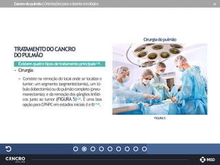 Cancrodopulmão|Orientaçõesparaodoenteoncológico 24
TRA
T
AMENTODOCANCRO
DOPULMÃO
Existemquatrotiposdetratamentoprincipais1,2,8.
» Cirurgia:
» Consiste na remoção do local onde se localiza o
tumor: um segmento (segmentectomia), um ló-
bulo(lobectomia)oudopulmãocompleto(pneu-
monectomia); e da remoção dos gânglios linfáti-
cos junto ao tumor (FIGURA 5)1,2,8. É uma boa
opçãoparaCPNPCemestádiosiniciais(IeII)1,1
1,16.
FIGURA5
Cirurgiadopulmão
 