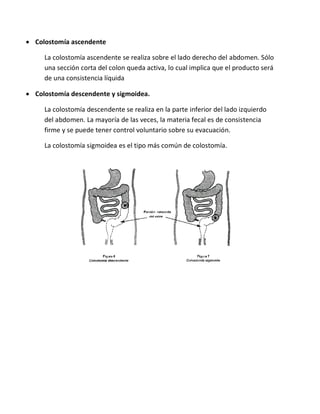  Colostomía ascendente
La colostomía ascendente se realiza sobre el lado derecho del abdomen. Sólo
una sección corta del colon queda activa, lo cual implica que el producto será
de una consistencia líquida
 Colostomía descendente y sigmoidea.
La colostomía descendente se realiza en la parte inferior del lado izquierdo
del abdomen. La mayoría de las veces, la materia fecal es de consistencia
firme y se puede tener control voluntario sobre su evacuación.
La colostomía sigmoidea es el tipo más común de colostomía.
 