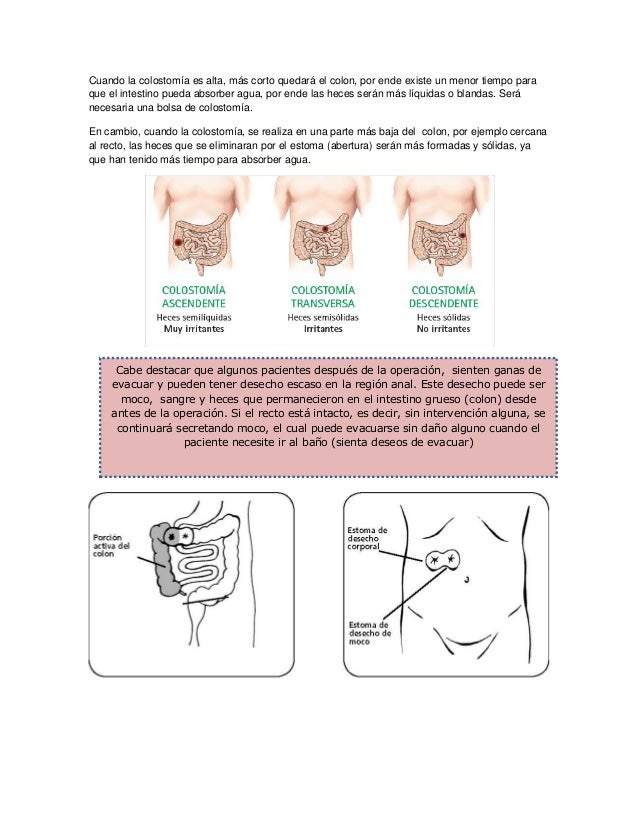 Manual colostomia Manual colostomia
